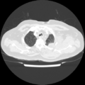 Acute heart failure (CT) (Radiopaedia 79835-93075 Axial lung window 6).png