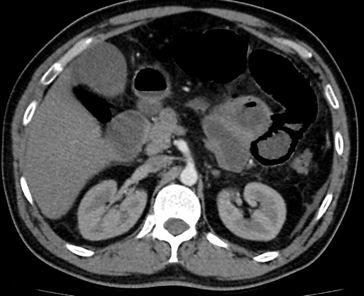 File:Acute mesenteric ischemia - superior mesenteric artery thrombosis (Radiopaedia 73947-84776 Axial C+ arterial phase 25).jpg