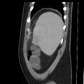 Acute on chronic calculous cholecystitis (Radiopaedia 55562-62050 Sagittal C+ portal venous phase 3).jpg