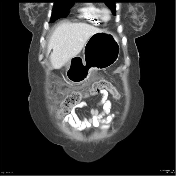 File:Acute pancreatitis (Radiopaedia 19136-19117 Coronal C+ portal venous phase 5).jpg