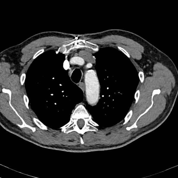 File:Acute pulmonary embolism (Radiopaedia 81677-95570 Axial C+ CTPA 5).jpg