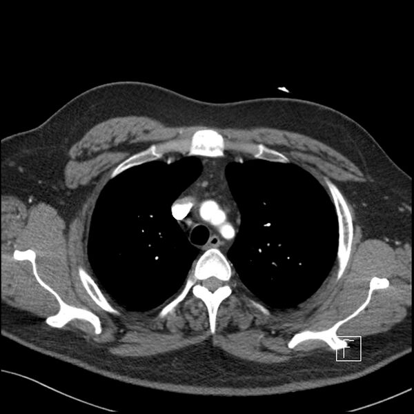 File:Acute pulmonary embolism with pulmonary infarct (Radiopaedia 73062-83768 Axial C+ CTPA 16).jpg