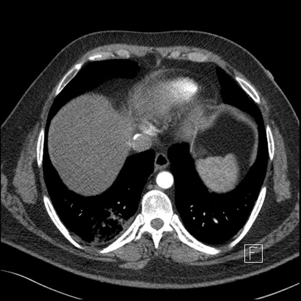 File:Acute pulmonary embolism with pulmonary infarct (Radiopaedia 73062-83768 Axial C+ CTPA 60).jpg