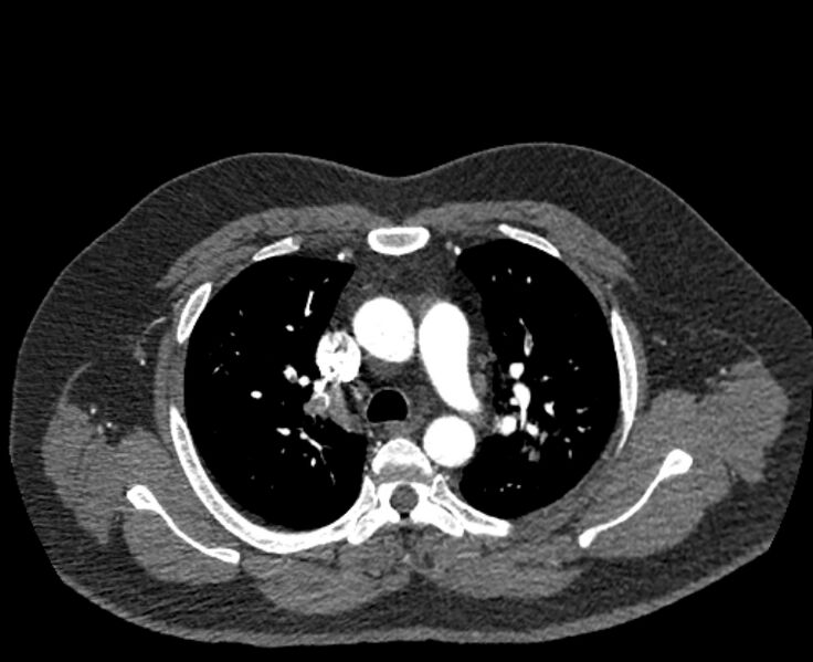 File:Acute pulmonary embolism with pulmonary infarcts (Radiopaedia 77688-89908 Axial C+ CTPA 20).jpg