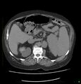 Acute renal failure post IV contrast injection- CT findings (Radiopaedia 47815-52559 Axial C+ portal venous phase 28).jpg