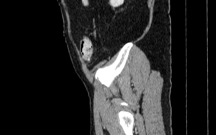 Acute sigmoid colon diverticulitis (Radiopaedia 55507-61976 Sagittal C+ portal venous phase 123).jpg