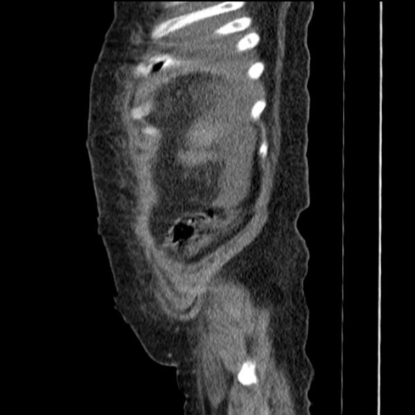 File:Acute tubular necrosis (Radiopaedia 28077-28334 H 13).jpg