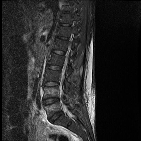 File:Acute vertebral body compression fractures (Radiopaedia 31757-32694 Sagittal STIR 11).jpg