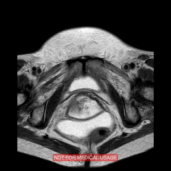 File:Adenocarcinoma of the cervix (Radiopaedia 28373-28615 Axial T2 4).jpg