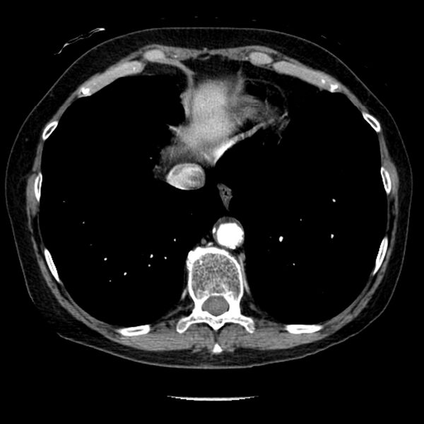 File:Adenocarcinoma of the lung (Radiopaedia 41015-43755 Axial C+ portal venous phase 96).jpg