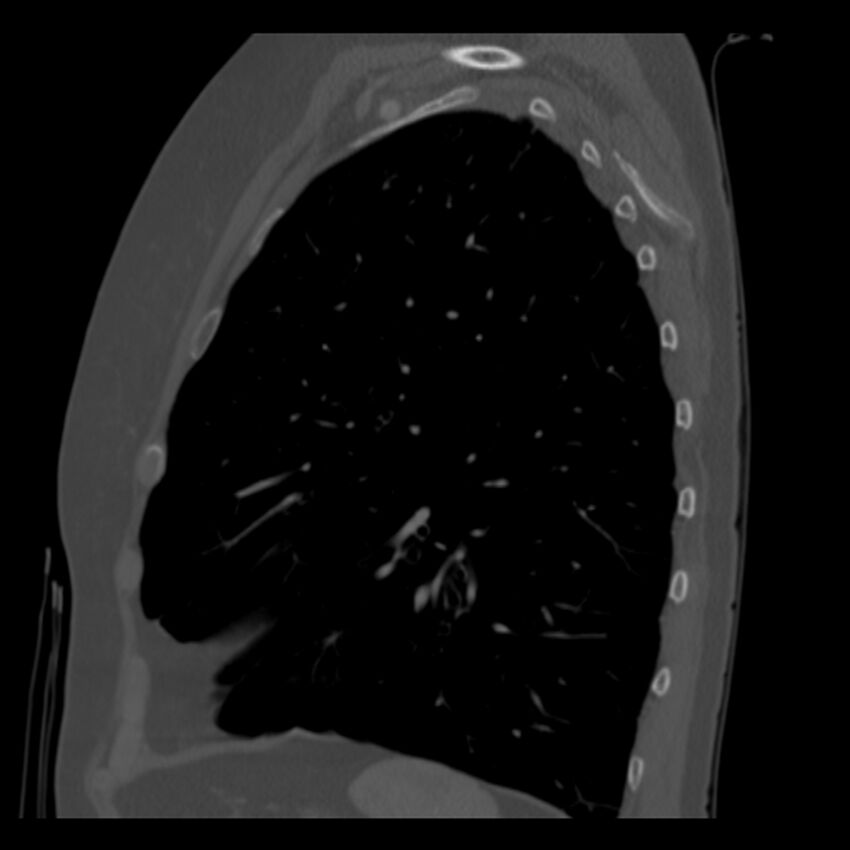 Adenocarcinoma of the lung (Radiopaedia 41015-43755 Sagittal bone window 80).jpg