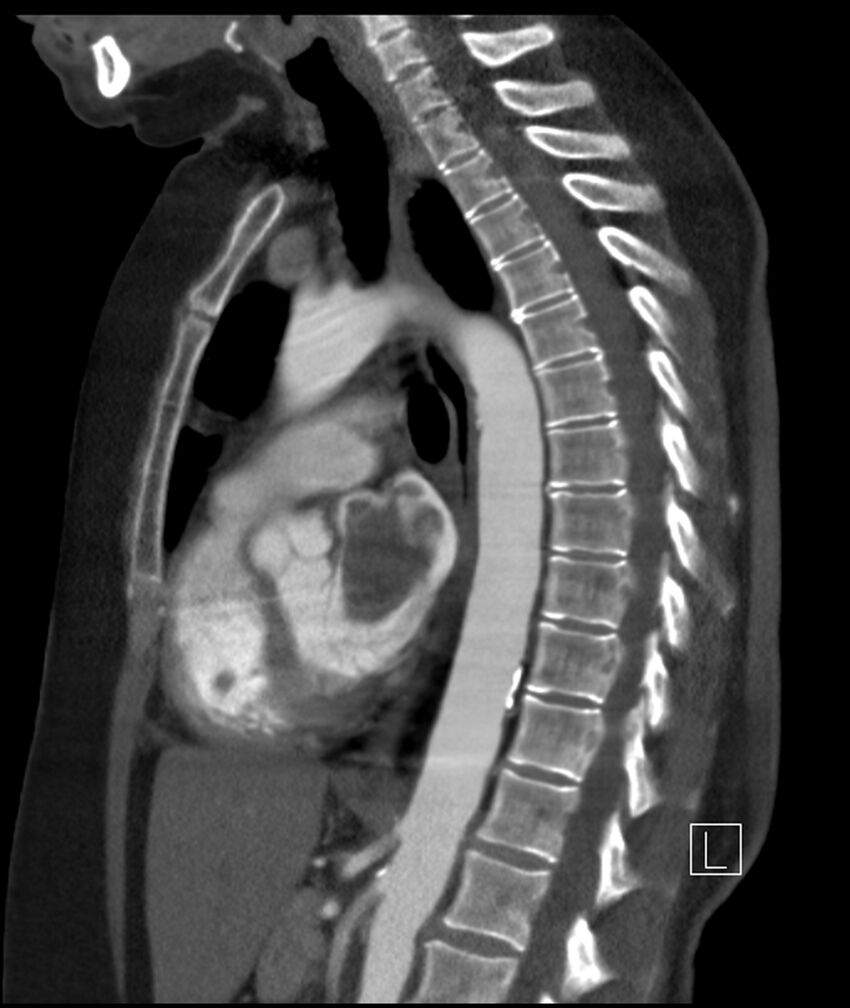 Adenocarcinoma of the lung (Radiopaedia 44205-47803 Sagittal C+ portal venous phase 27).jpg