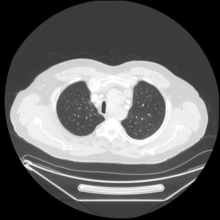 Adenocarcinoma of the lung (Radiopaedia 44876-48759 Axial lung window 13).jpg