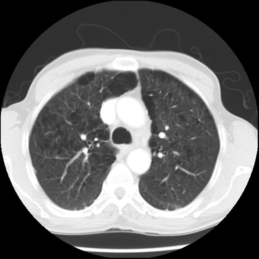 Adenocarcinoma of the lung - micropapillary predominant (Radiopaedia 42446-45563 Axial lung window 23).jpg