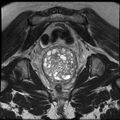 Adenoma malignum of the cervix (Radiopaedia 24460-24765 Coronal T2 21).jpg