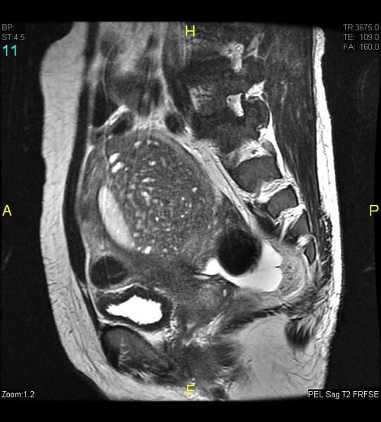 File:Adenomyosis (Radiopaedia 43504-46889 Sagittal T2 11).jpg