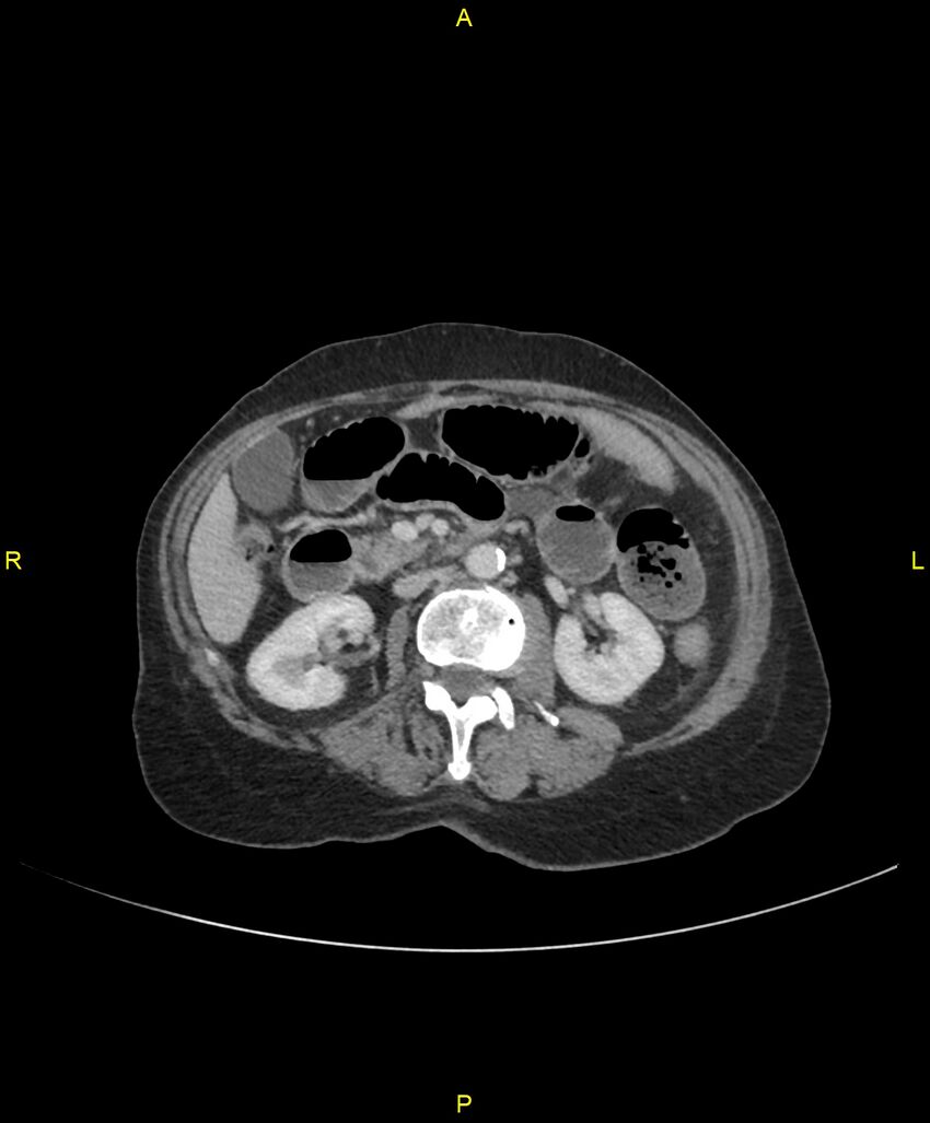Adhesional small bowel obstruction (Radiopaedia 85402-101024 Axial C+ portal venous phase 121).jpg