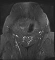 Adnexal multilocular cyst (O-RADS US 3- O-RADS MRI 3) (Radiopaedia 87426-103754 Coronal T2 fat sat 3).jpg