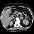 Adrenal hemangioma (Radiopaedia 11039-11445 Axial C+ arterial phase 7).jpg