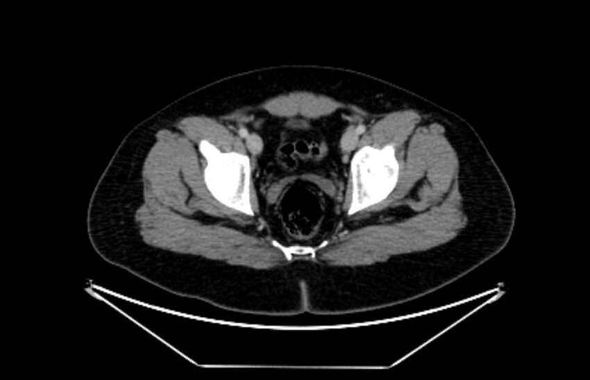 Adrenocortical carcinoma (Radiopaedia 80134-93438 Axial C+ portal venous phase 121).jpg
