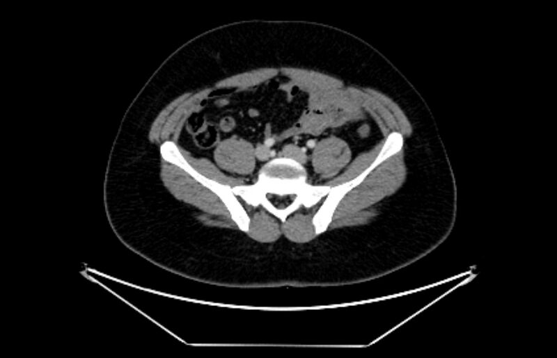 File:Adrenocortical carcinoma (Radiopaedia 80134-93438 Axial C+ portal venous phase 94).jpg