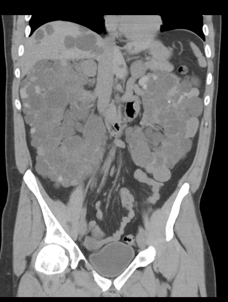 File:Adult polycystic kidney disease (Radiopaedia 47866-52626 Coronal non-contrast 22).png