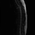 Aggressive vertebral hemangioma (Radiopaedia 39937-42404 Sagittal T2 7).png