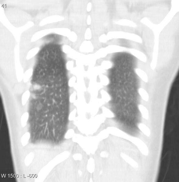 File:Air crescent sign (aspergilloma) (Radiopaedia 14380-14306 Coronal lung window 8).jpg