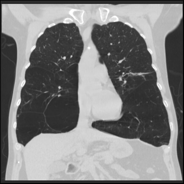 File:Alpha-1-antitrypsin deficiency (Radiopaedia 40993-43722 Coronal lung window 37).jpg