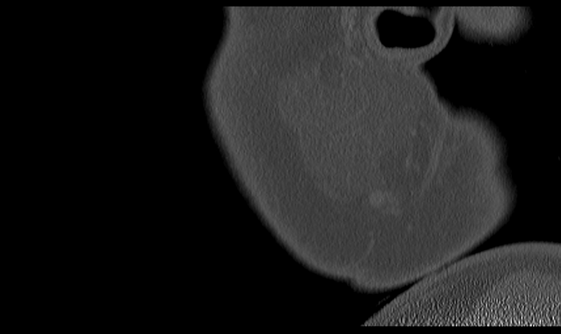 File:Ameloblastoma (Radiopaedia 33677-34806 Sagittal bone window 7).png
