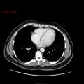 Ampullary carcinoma (Radiopaedia 56396-63056 C 3).jpg
