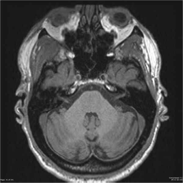 File:Anaplastic meningioma with recurrence (Radiopaedia 34452-35788 Axial T1 29).jpg