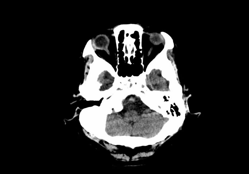 File:Anomalous intracranial venous drainage (Radiopaedia 28161-28418 Axial non-contrast 7).jpg