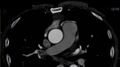 Anomalous left coronary artery- prepulmonic course (Radiopaedia 29253-29667 A 3).JPG