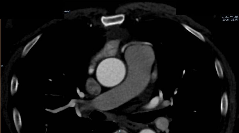 File:Anomalous left coronary artery- prepulmonic course (Radiopaedia 29253-29667 A 3).JPG
