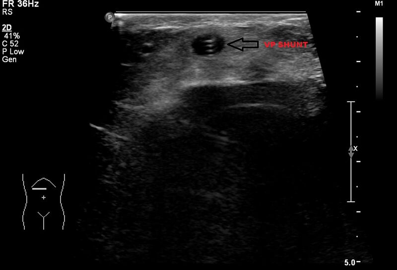 File:Anterior abdominal wall CSF pseudocyst (CSFoma) (Radiopaedia 79453-92570 Transverse 1).JPG