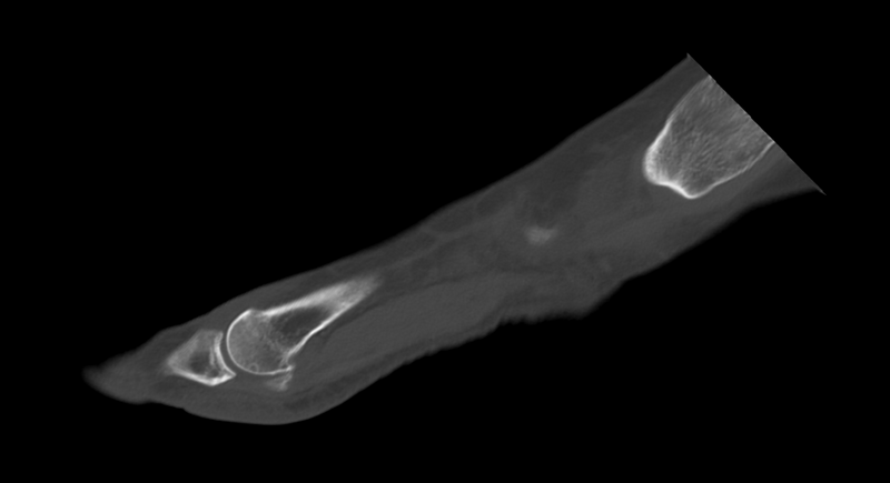 File:Anterior calcaneal process fracture (Radiopaedia 47384-51989 Sagittal bone window 26).png