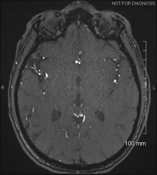 File:Anterior cerebral artery aneurysm (Radiopaedia 80683-94127 Axial MRA 124).jpg