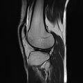 Anterior cruciate ligament full thickness tear (Radiopaedia 66268-75467 Sagittal T2 17).jpg