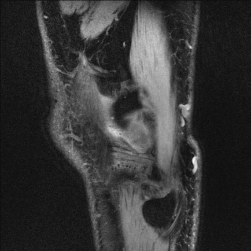 Anterior cruciate ligament mucoid degeneration (Radiopaedia 68400-77933 Sagittal 3).jpg