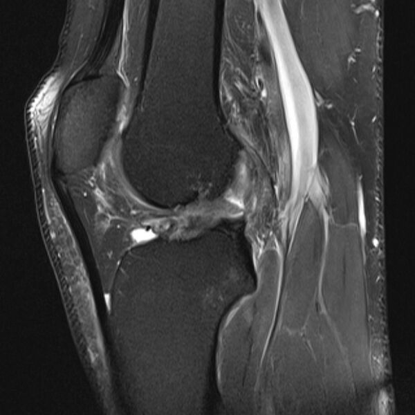 File:Anterior cruciate ligament tear - ramp lesion (Radiopaedia 71883-82322 Sagittal PD fat sat 12).jpg