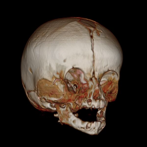 File:Anterior plagiocephaly (Radiopaedia 71836-82273 E 9).jpg