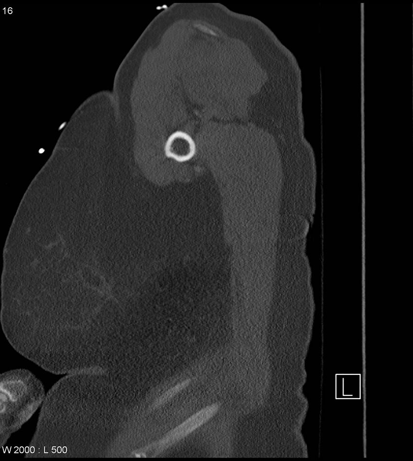 Anterior shoulder dislocation (CT) (Radiopaedia 59032-66309 Sagittal bone window 8).jpg