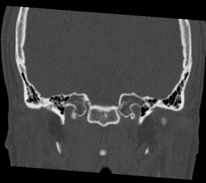 File:Antrochoanal polyp (Radiopaedia 21894-21868 Coronal bone window 38).jpg