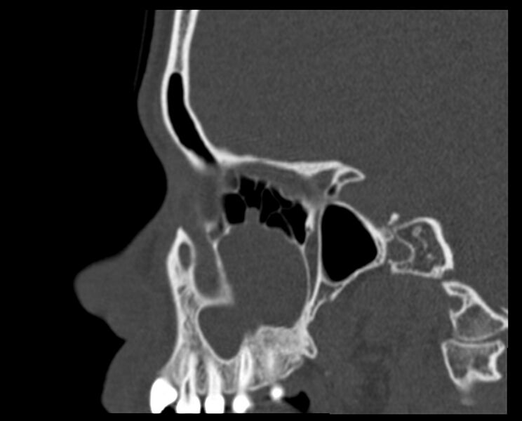 File:Antrochoanal polyp (Radiopaedia 21894-21868 Sagittal bone window 13).jpg