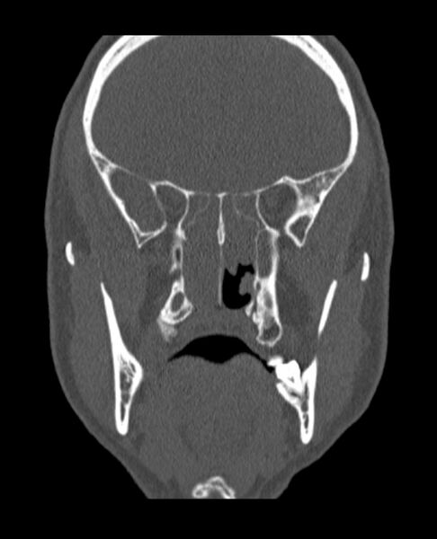 File:Antrochoanal polyp (Radiopaedia 79011-92169 Coronal bone window 33).jpg