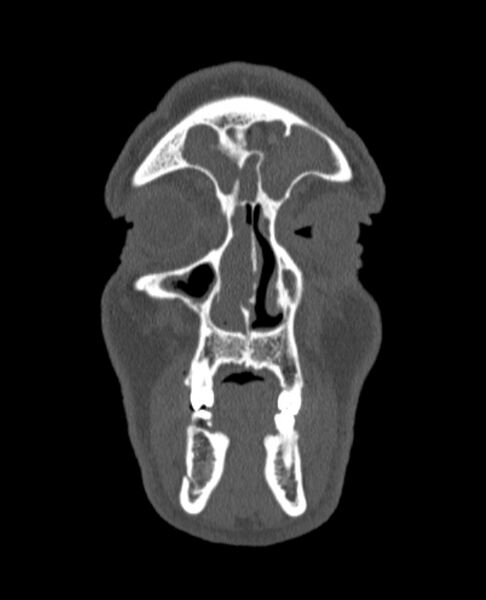 File:Antrochoanal polyp (Radiopaedia 79011-92169 Coronal bone window 73).jpg