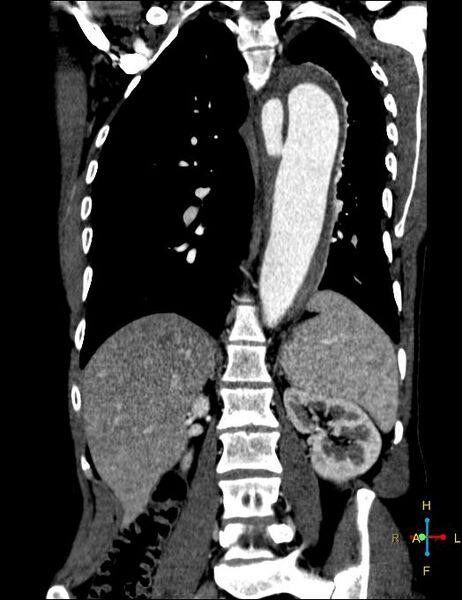 File:Aortic aneurysm and penetrating ulcer (Radiopaedia 23590-23704 B 16).jpg