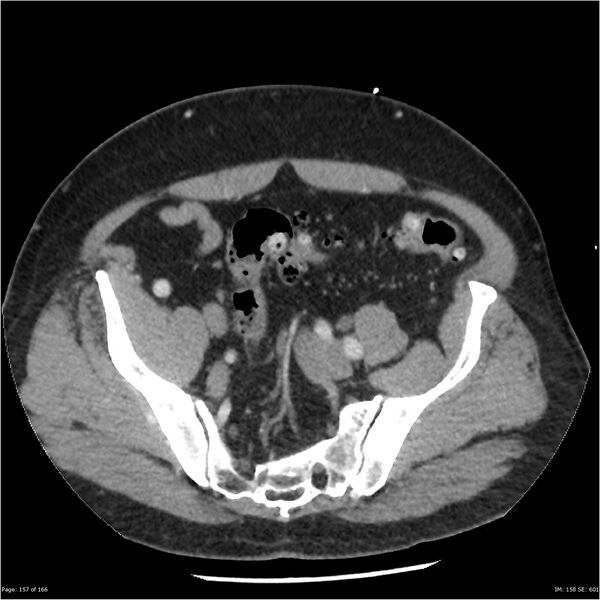 File:Aortic dissection- Stanford A (Radiopaedia 37759-39664 A 148).jpg
