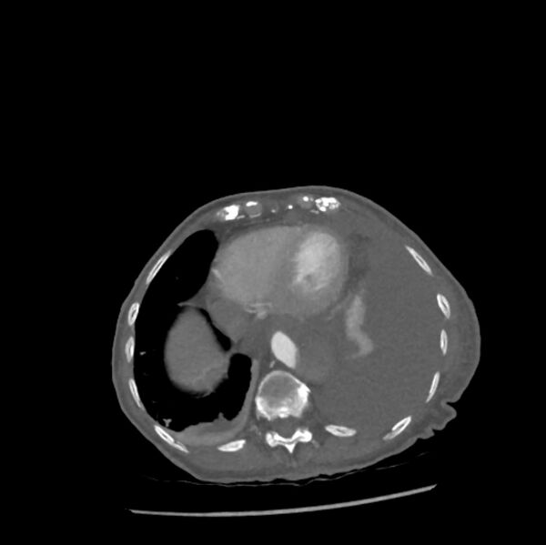 File:Aortic dissection (Radiopaedia 68763-78691 A 45).jpeg